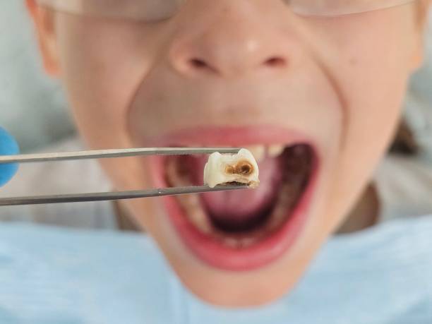 Best Emergency Root Canal Treatment in White Marsh, MD